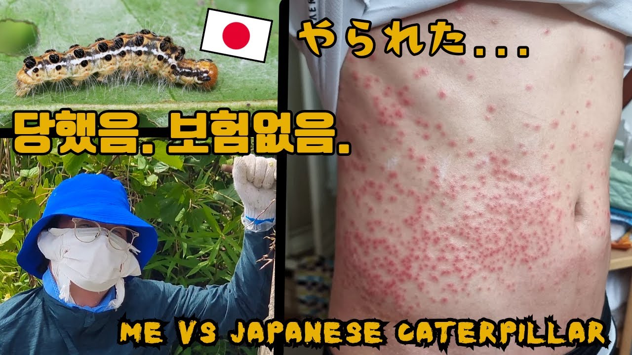 일본 처가에서 벌레한테 당함/Tae Vs Poisonous Japanese Caterpillar/嫁の実家で毛虫にやられました