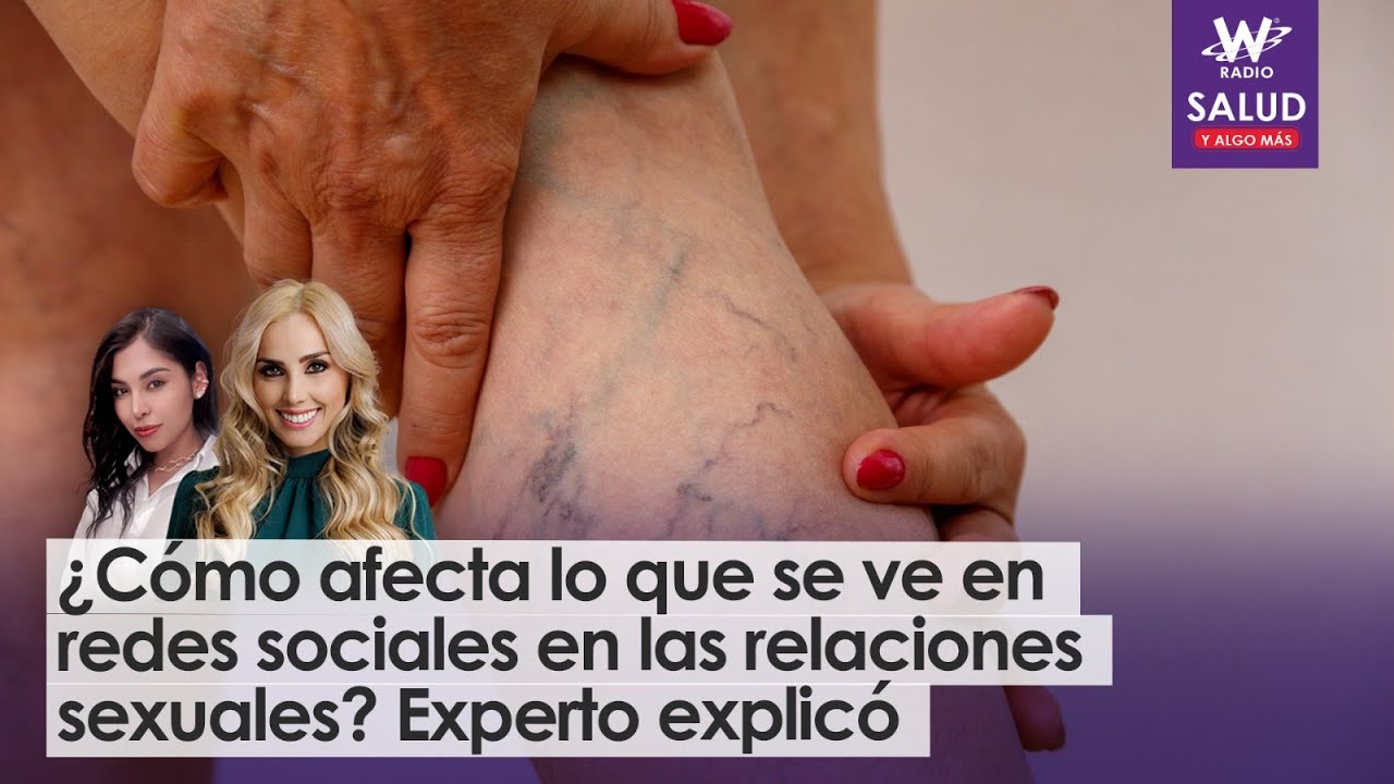 ¿Cuáles son los riesgos de no tratar a tiempo las venas várices? Médico explicó | Salud y Algo Más