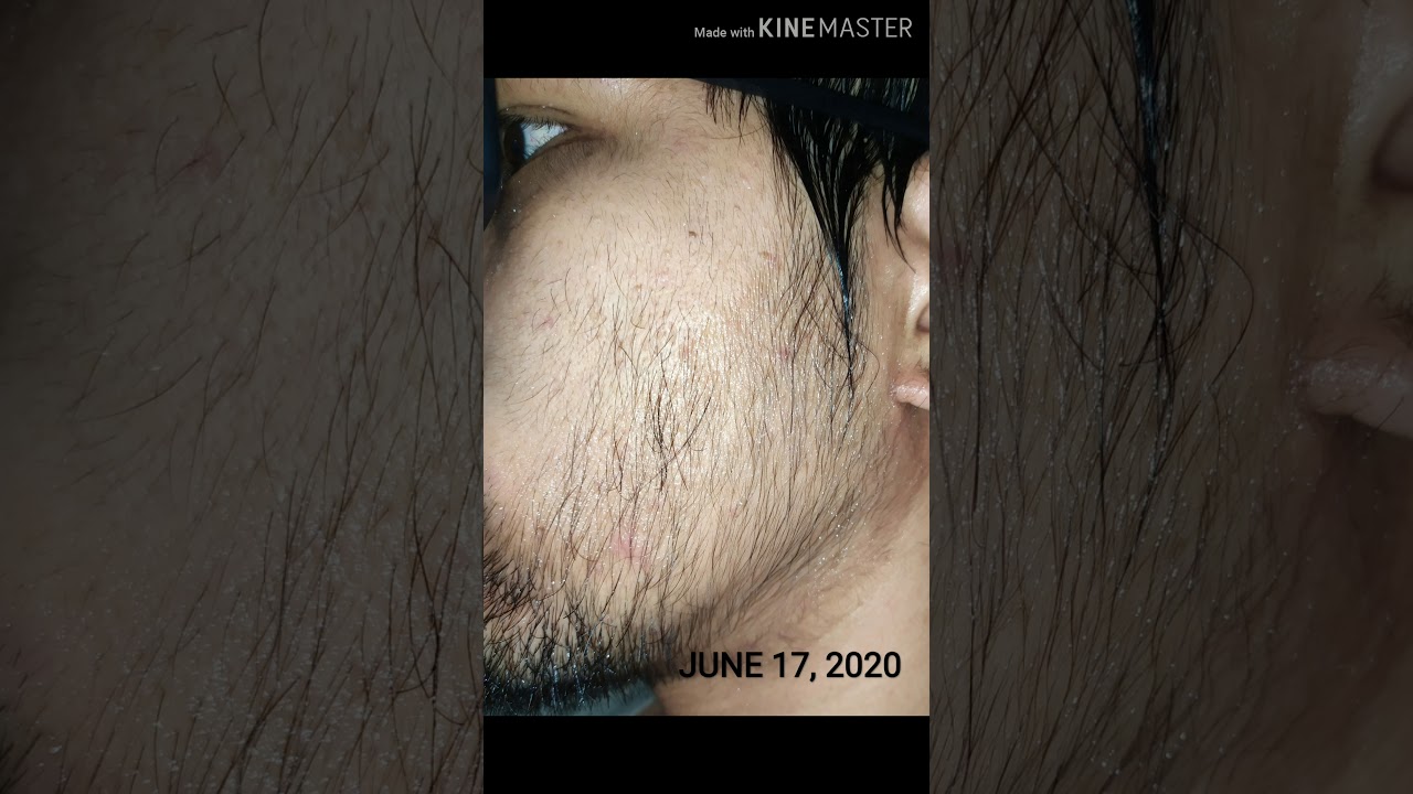 Minoxidil Beard Journey || Apr.24 - Jul. 13 (81 days)