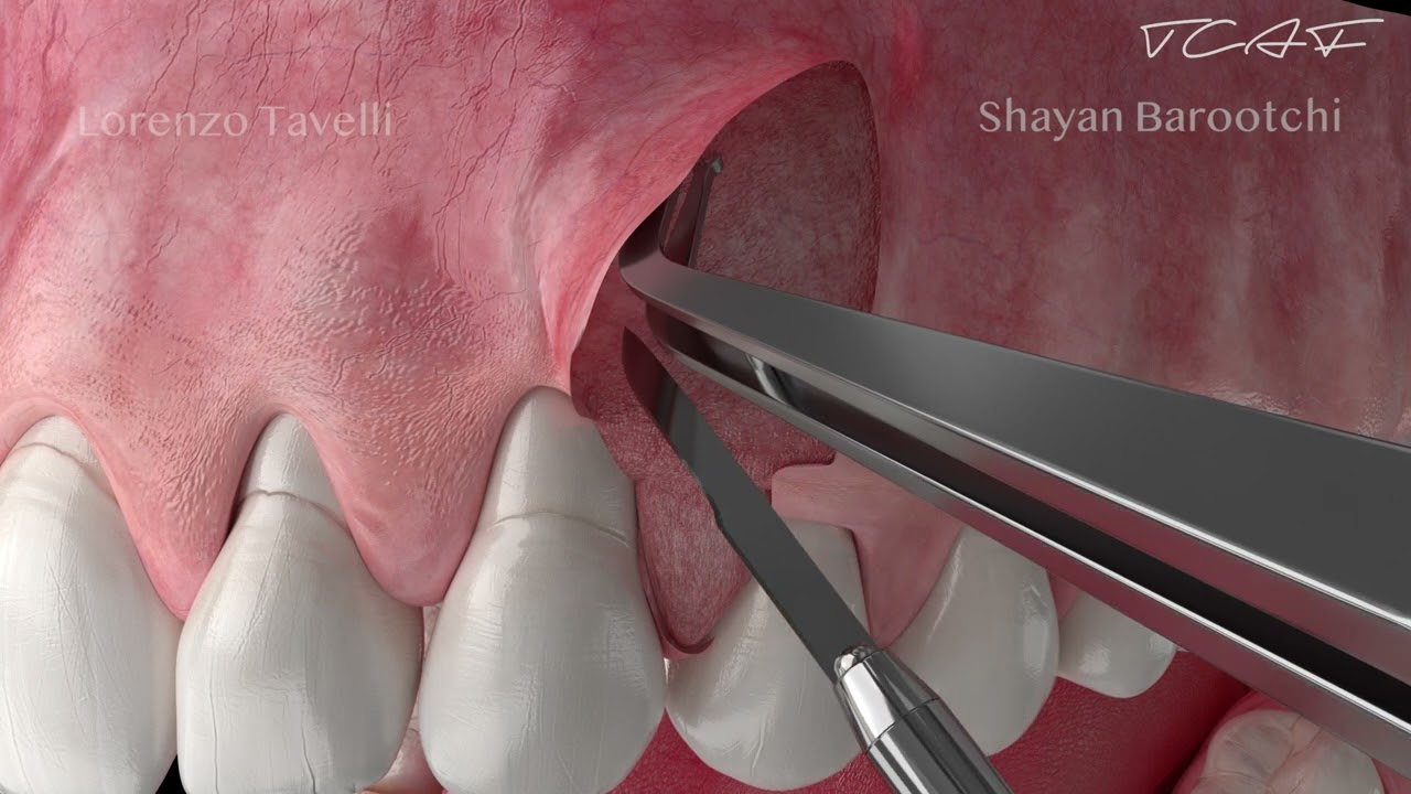 Dental Animation - The Tunneled Coronally Advanced Flap (TCAF)