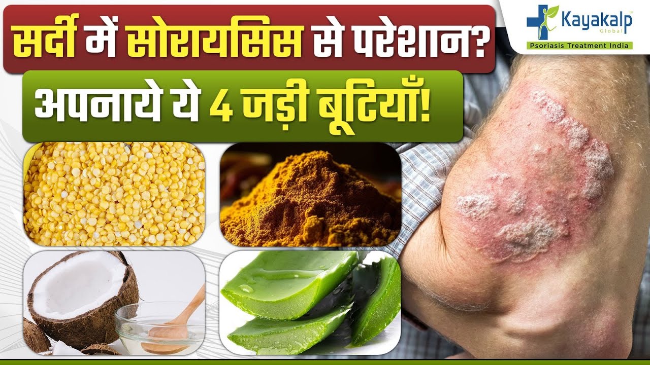 सर्दी में सोरायसिस से परेशान? अपनाये ये 4 जड़ी बूटियाँ! | 4 Herbs for Psoriasis Recovery