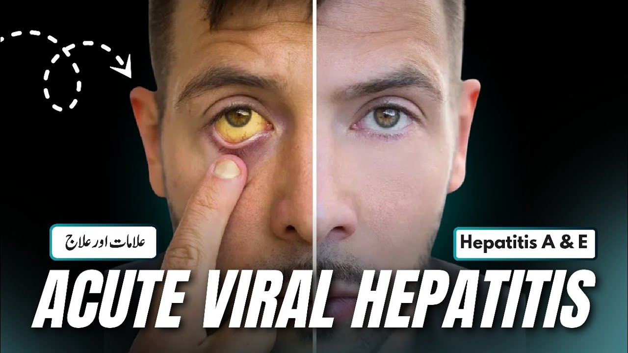 Acute Viral Hepatitis,Hepatitis A and Hepatitis E
