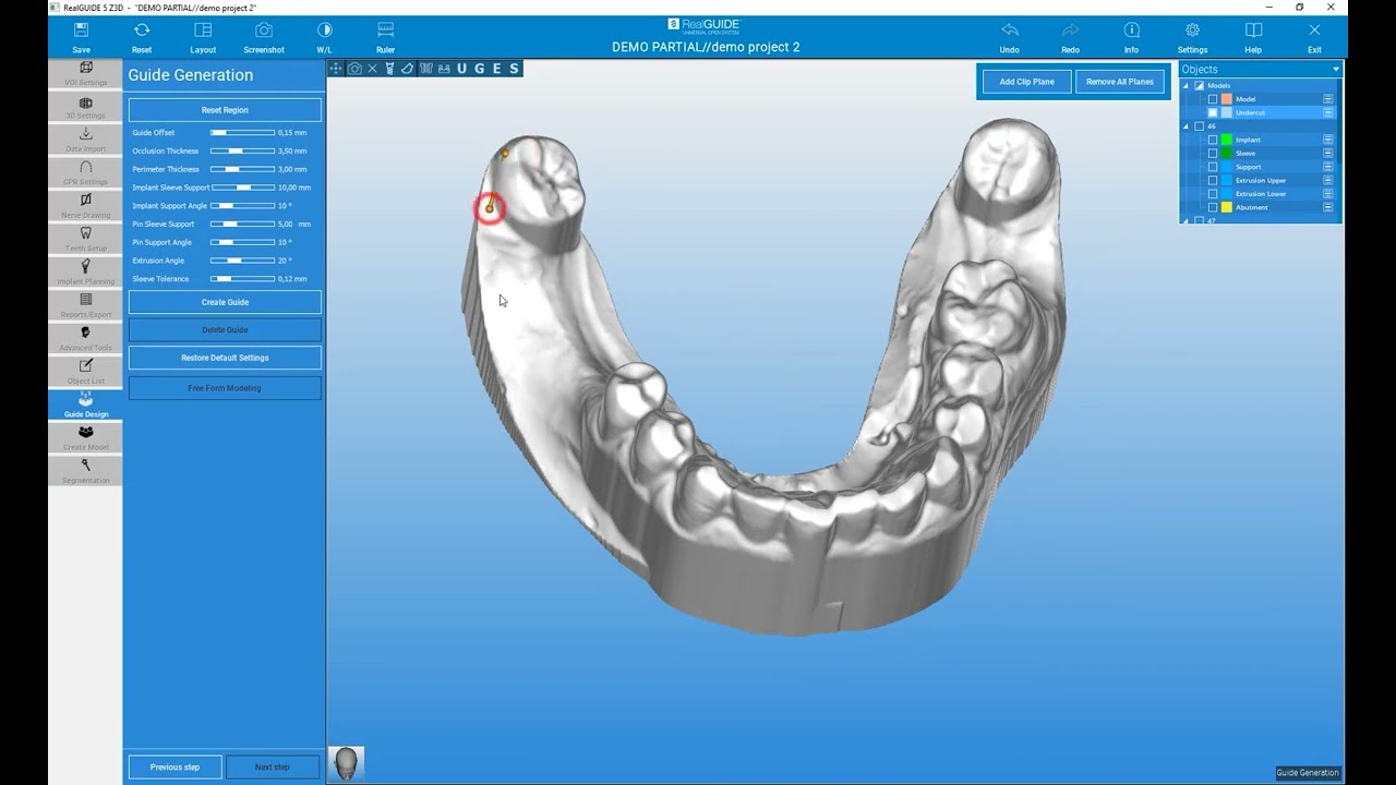 RealGUIDE Software   Surgical Guide Modeling