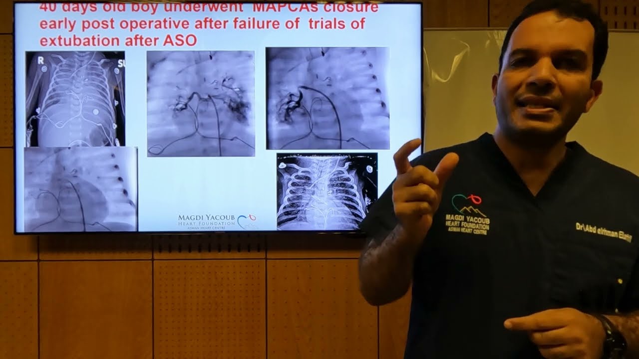 Trans-catheter Interventions in TGA - Abdelrahman Elafifi