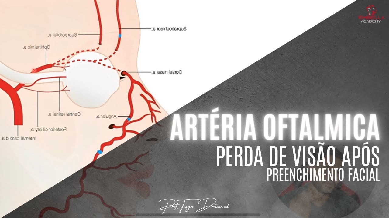 Artéria oftálmica e perda de visão após preenchimento facial