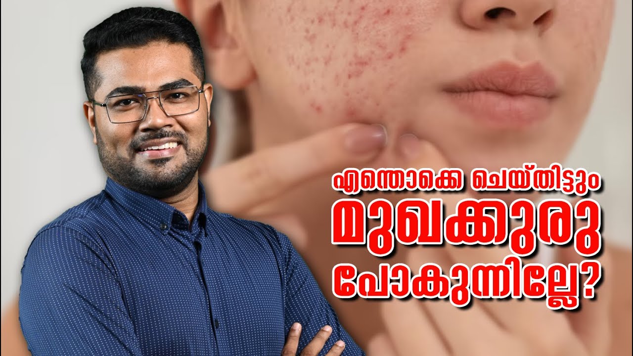 എന്തൊക്കെ ചെയ്തിട്ടും മുഖക്കുരു പോകുന്നില്ലേ? മുഖക്കുരു  ശ്രദ്ധിക്കേണ്ട കാര്യങ്ങൾ -Dr. Manoj Johnson