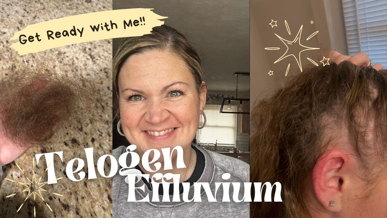 GRWM as I cover my bald spots! [Female Hair loss from Telogen Effluvium]