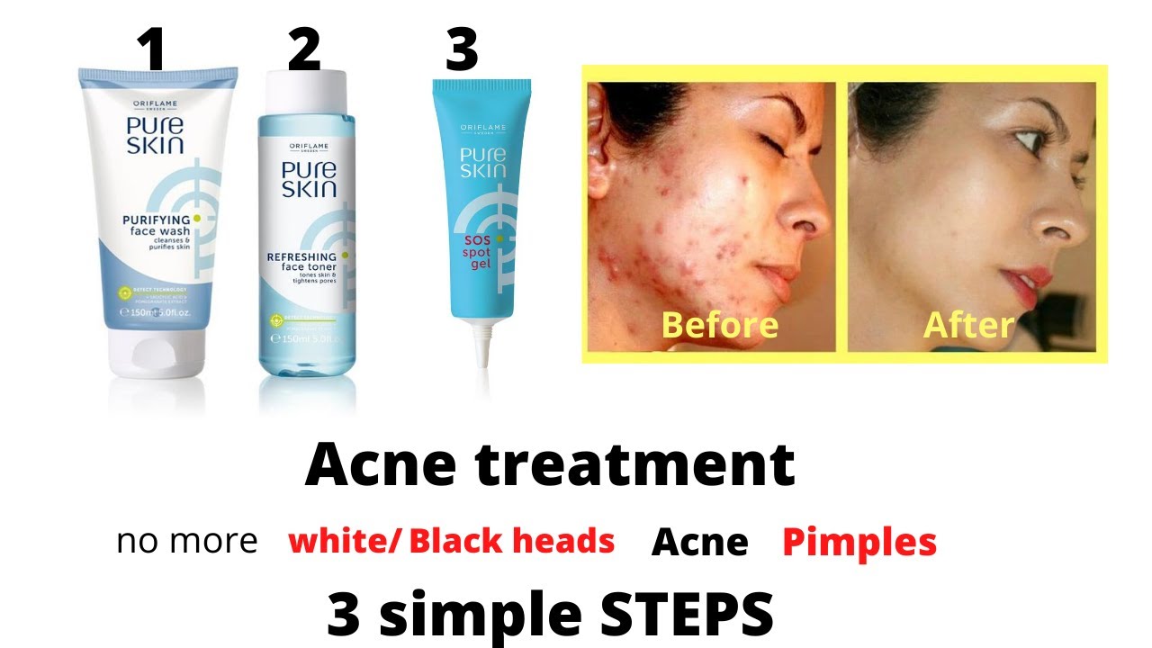 Acne Treatment| Oriflame Pure Skin Purifying Face Wash, Toner and SOS spot gel Review| Flawless Skin
