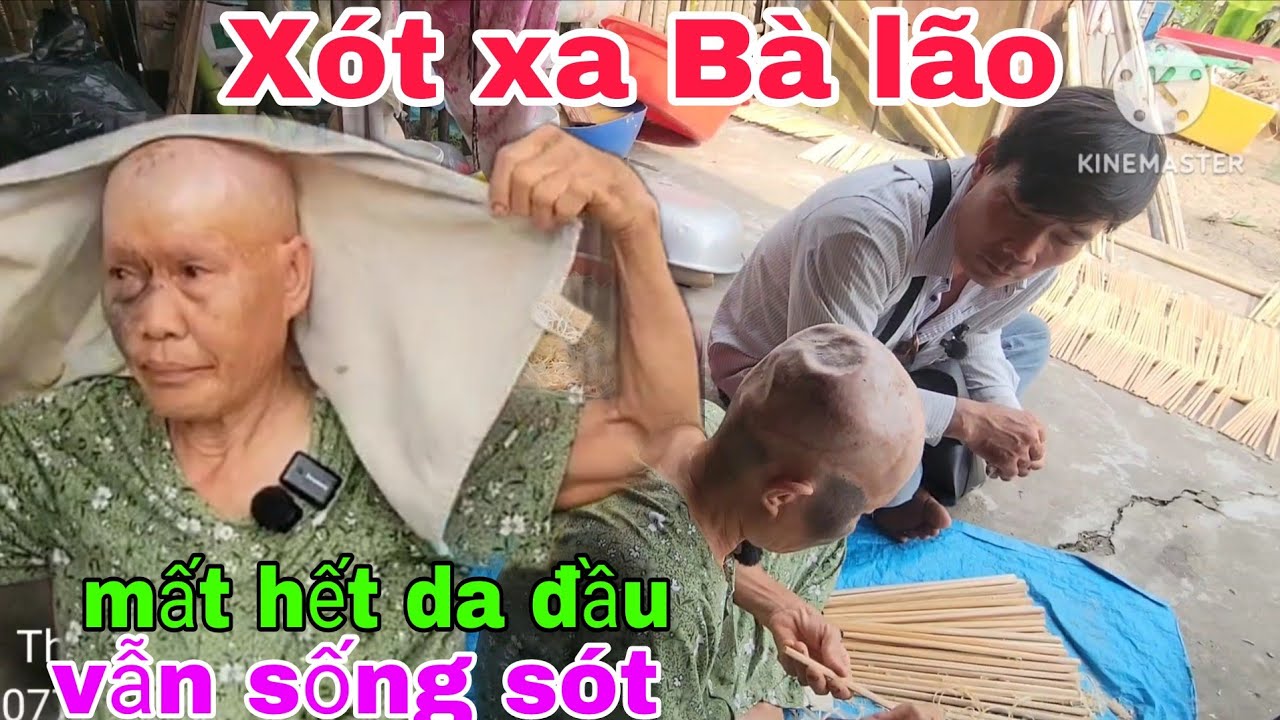 Xót xa Bà lão lột cả da đầu vẫn sống sót. Thiện Tâm 
