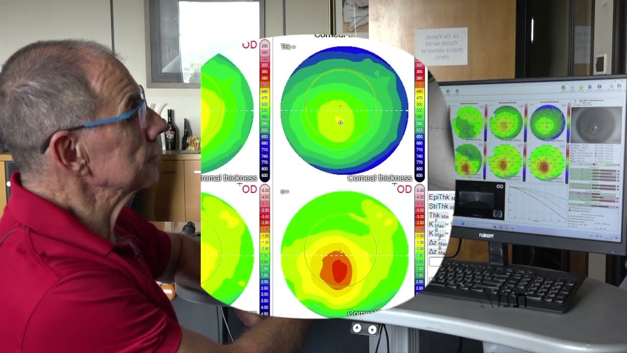 מכשיר או.סי.טי קרנית | CSO MS-39 Anterior Segment