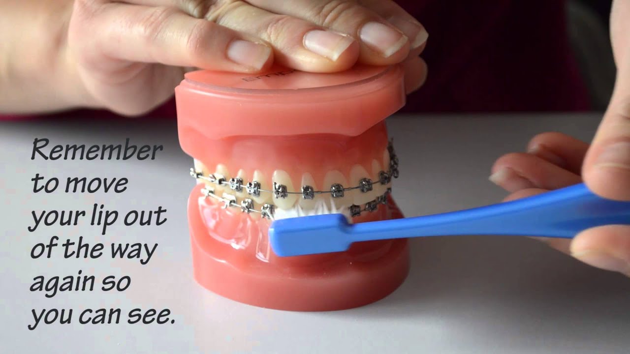How do I brush with braces?
