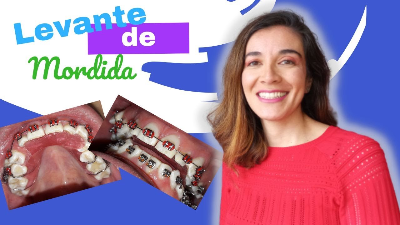 La mejor forma de levantar la mordida. PLACAS LEVANTADORAS DE MORDIDA