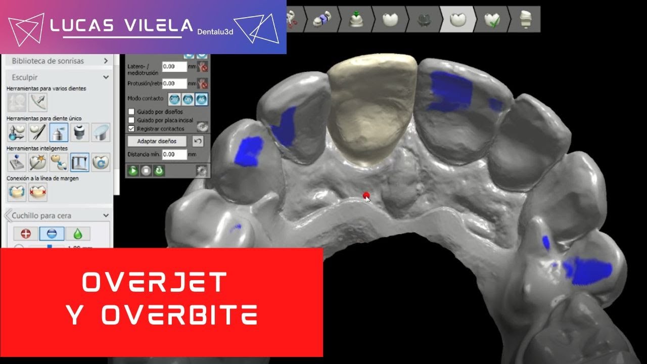 OVERJET Y OVERBITE / 3SHAPE