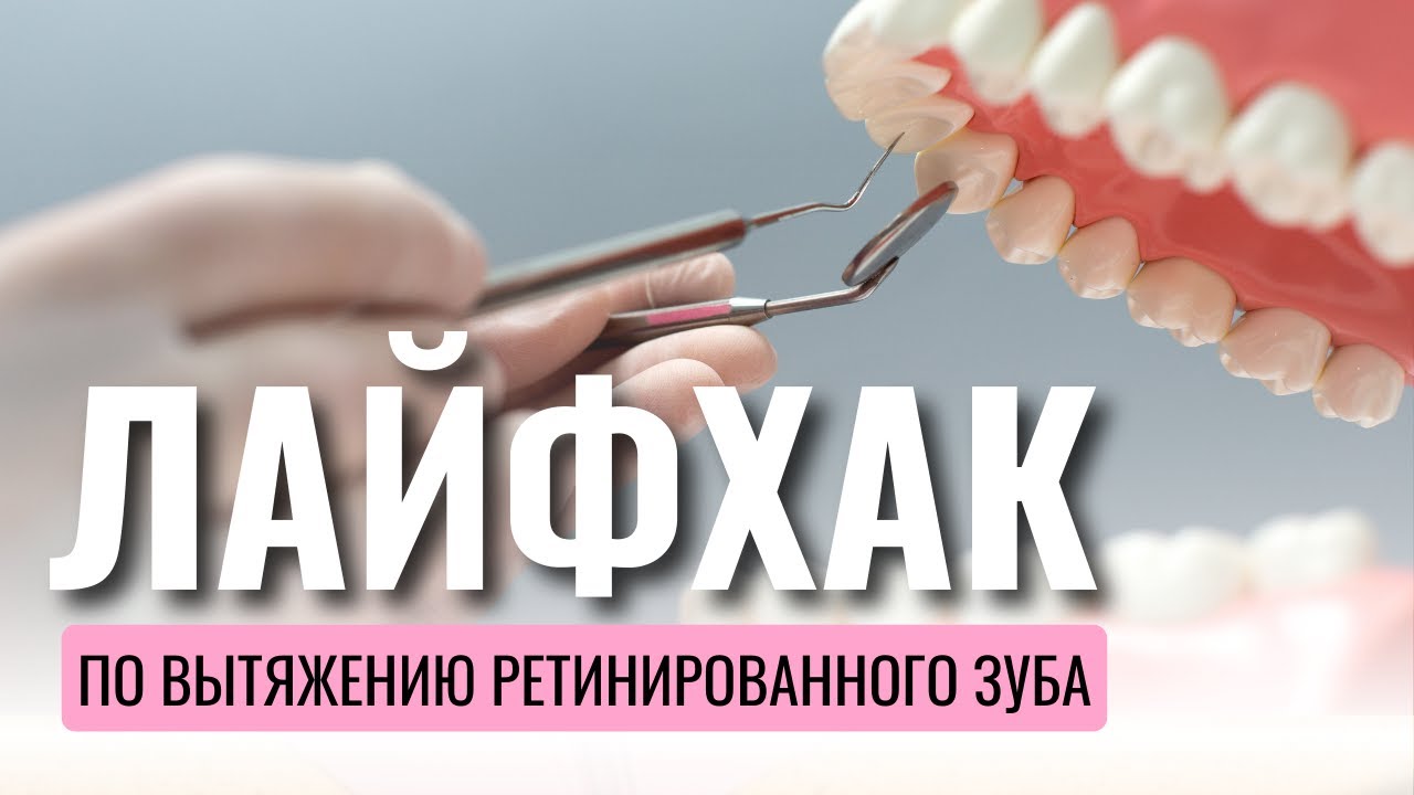 Лайфхак по вытяжению ретинированного зуба