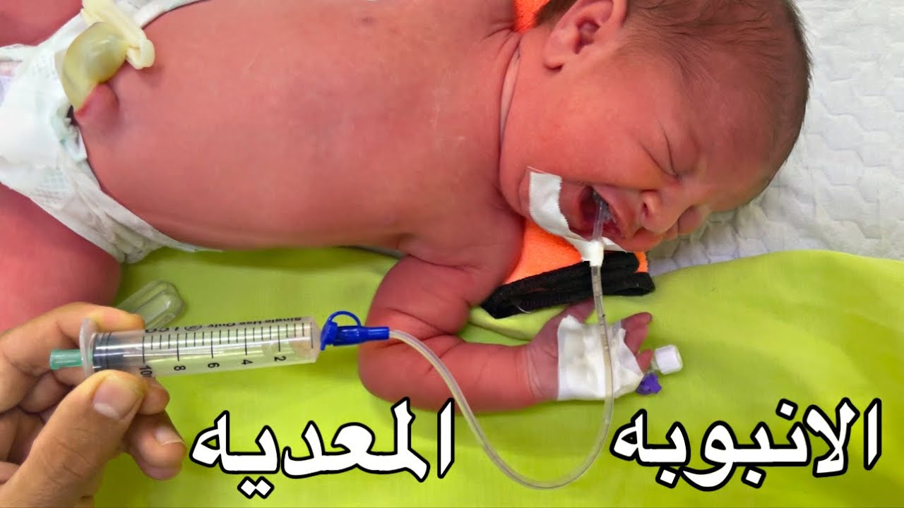 تركيب انبوبه المعده للاطفال حديثى الولاده - The How to Make an Orogastric Tube for Kids Case