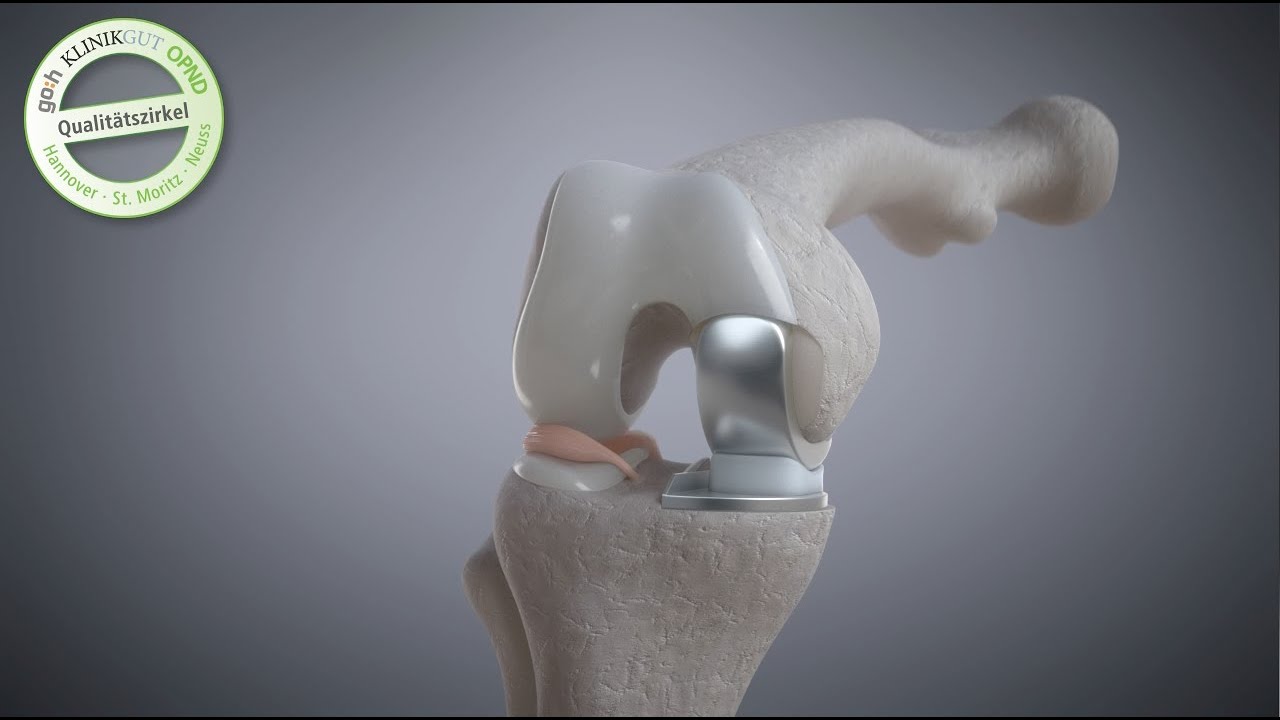 Mediale Arthrose am Knie: Teilprothese Oxford Schlitten