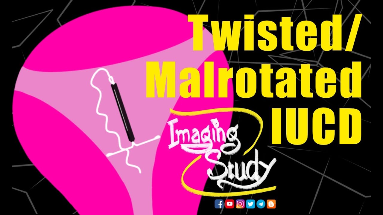 Twisted/ Malrotated Intrauterine Contraceptive Device || IUCD || Ultrasound || Case 233