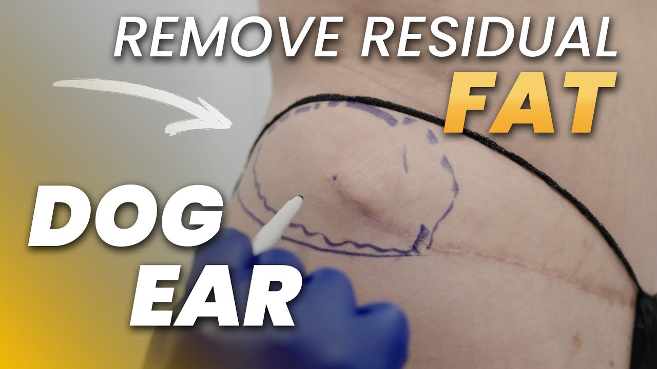 Tummy Tuck Left a Bulge? Let’s Talk Dog Ears and Residual Fat
