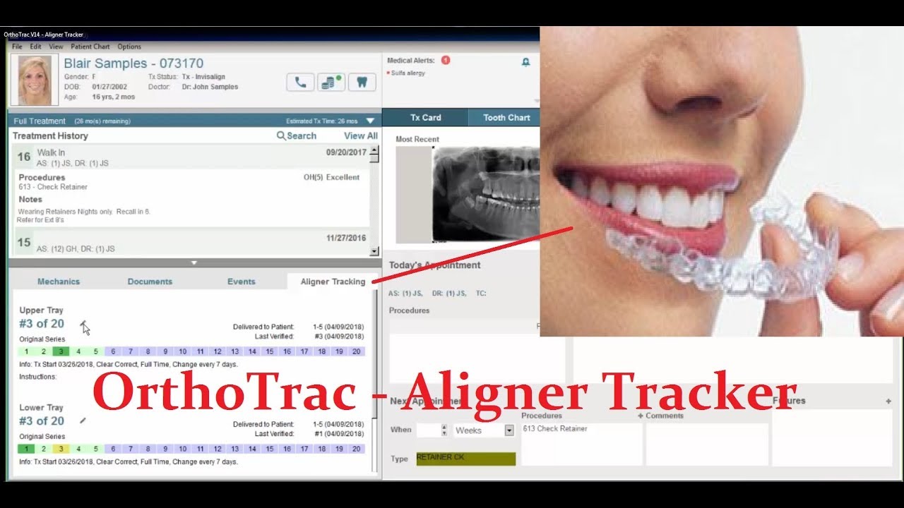 OrthoTrac (V14) - Aligner Tracker