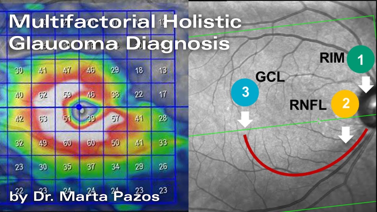 Multifactorial Holistic Glaucoma Diagnosis – Marta Pazos