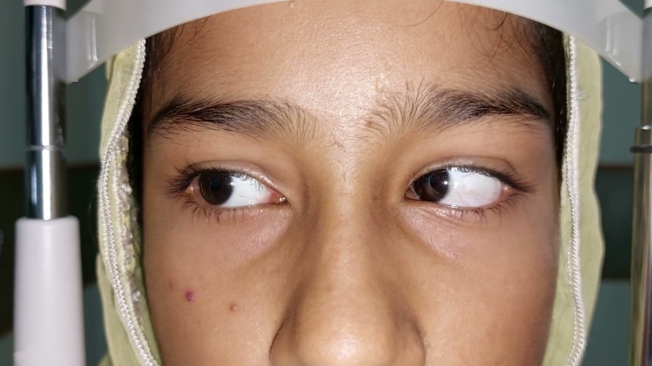 Squint examination