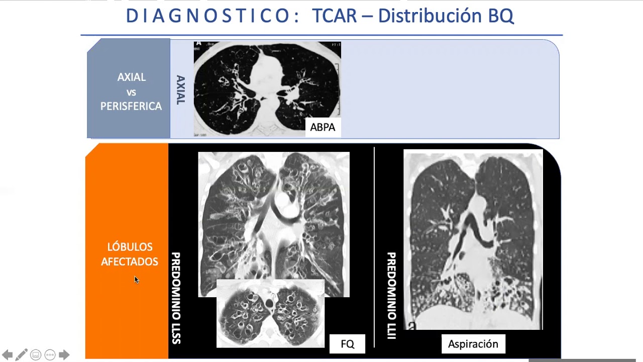 Bronquiectasias (Dra. Ana Inés Gruss) - Módulo Respiratorio
