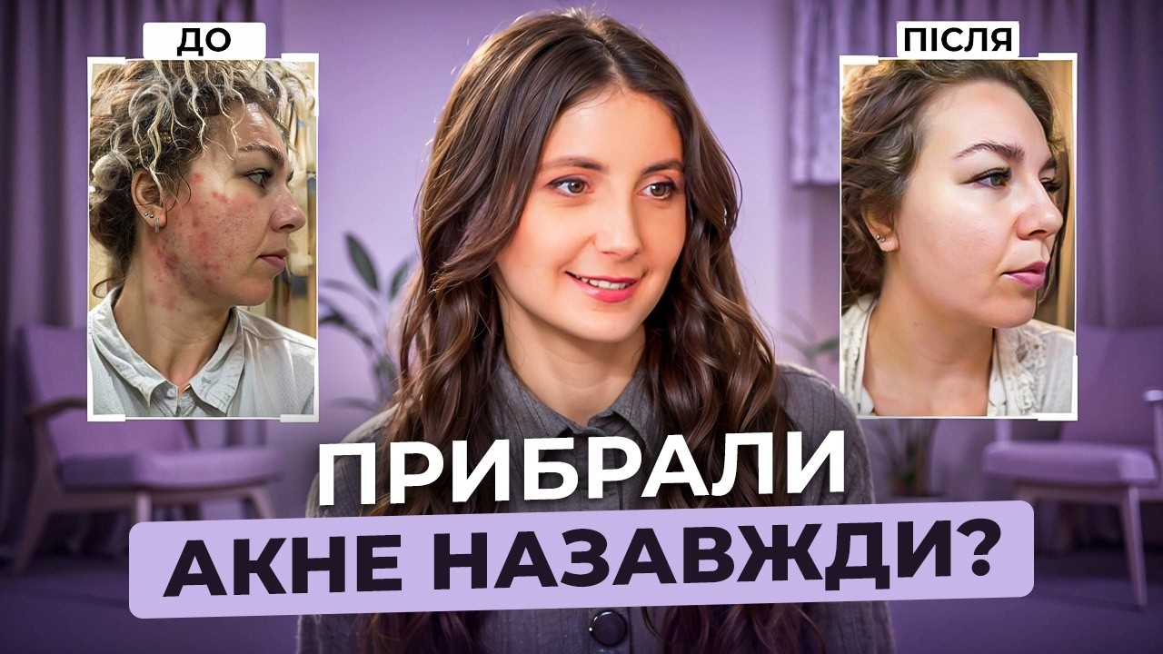 Я жила з акне 15 років — ось що насправді допомогло