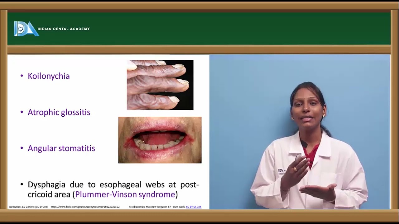 ANEMIA | General Medicine for Dentists | #NEET#MDS#BDS#NBDE#ORE#DDS
