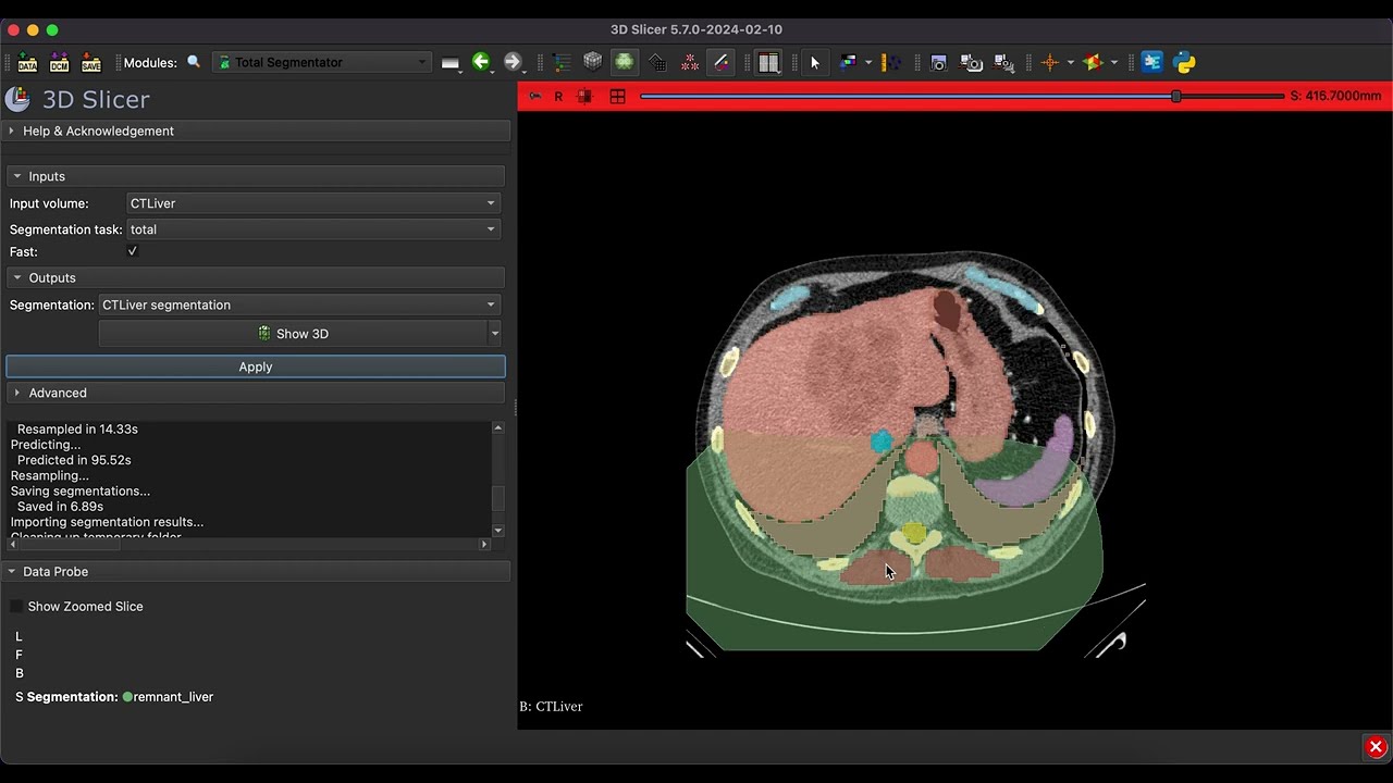 Liver Volumetry Using 3DSlicer - Tutorial