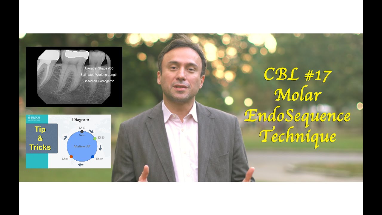 CBL #17 Molar with the EndoSequence Technique