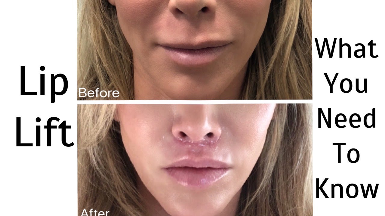 All About My Lip Lift Procedure with my Dr!