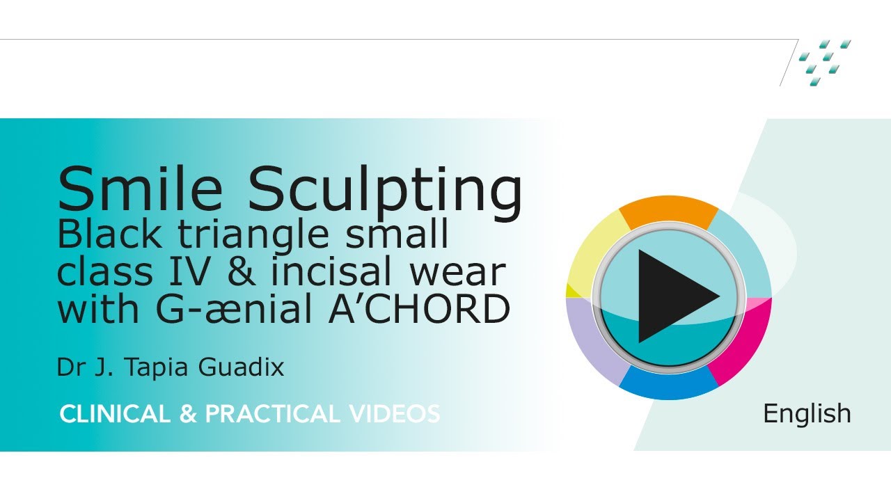 Smile Sculpting: black triangle small class IV & incisal wear with G-ænial A'CHORD (long version)