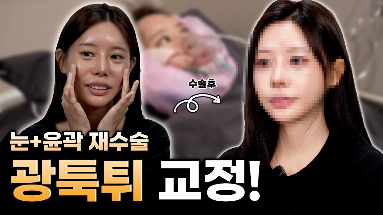 수술했는데도 튀어나온 광대 😱  안 해주면 실망할 것 같다는 그녀 1편 ✨ 광툭튀  재수술