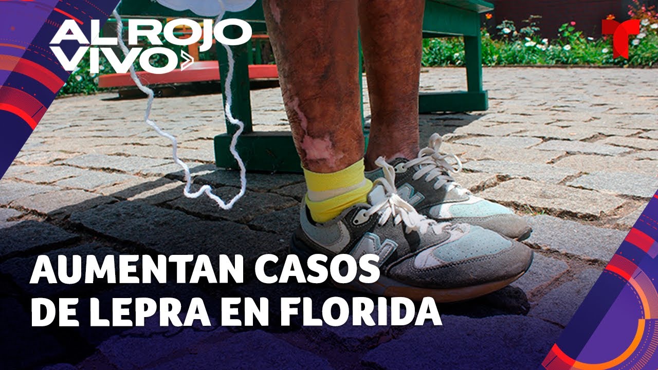 Autoridades emiten alertas de salud por el aumento de casos de lepra en Florida