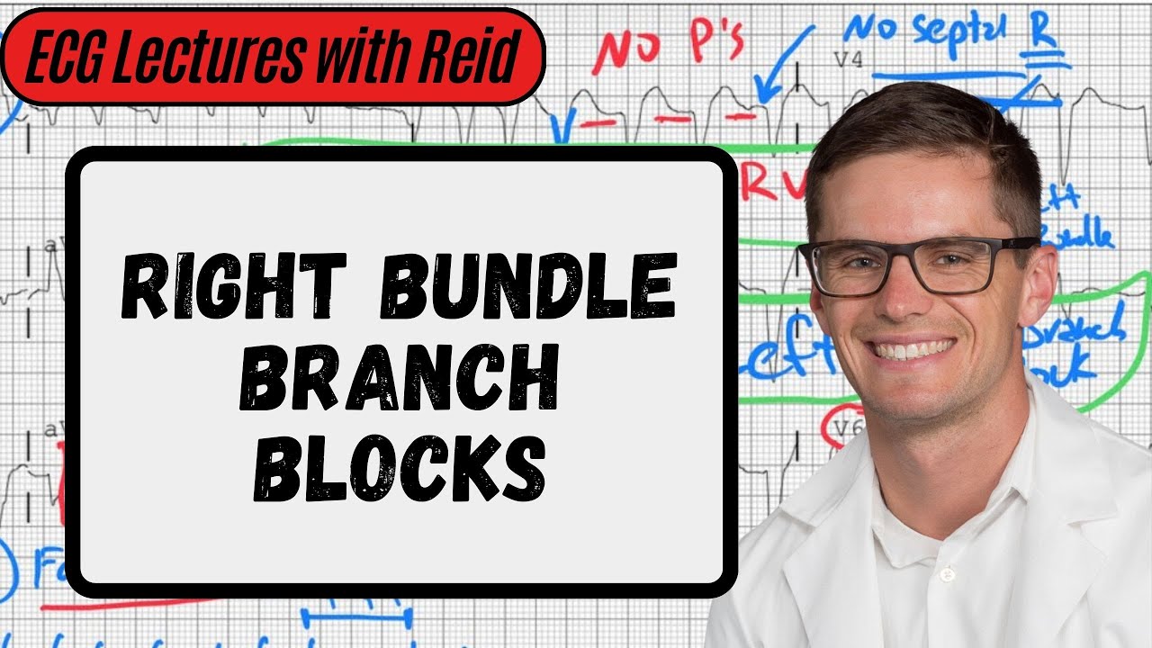 Right Bundle Branch Blocks | Day 9 ECG Challenge