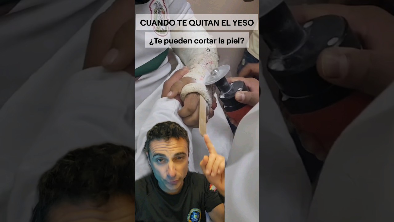 Cuanto te quitan el yeso, &iquest;Te pueden cortar?.#curiosidades #supervivencia #emergencia