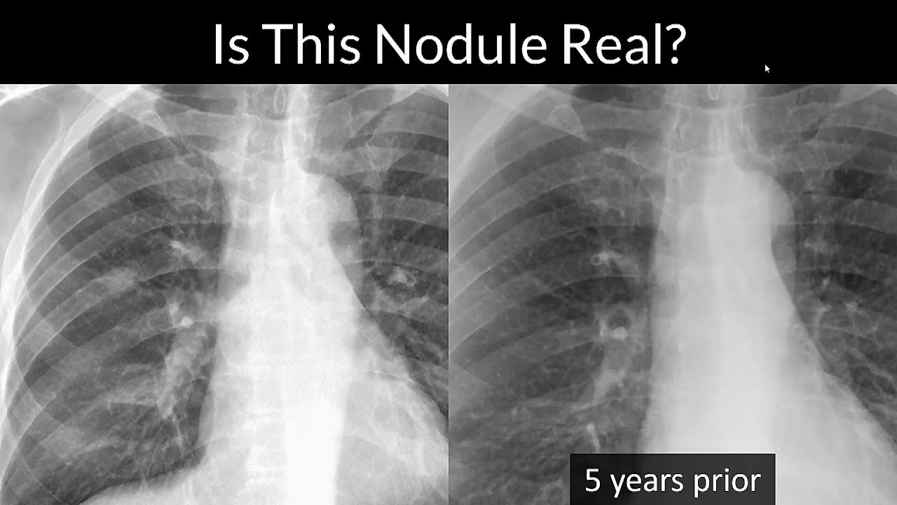 Is This Lung Nodule Real?
