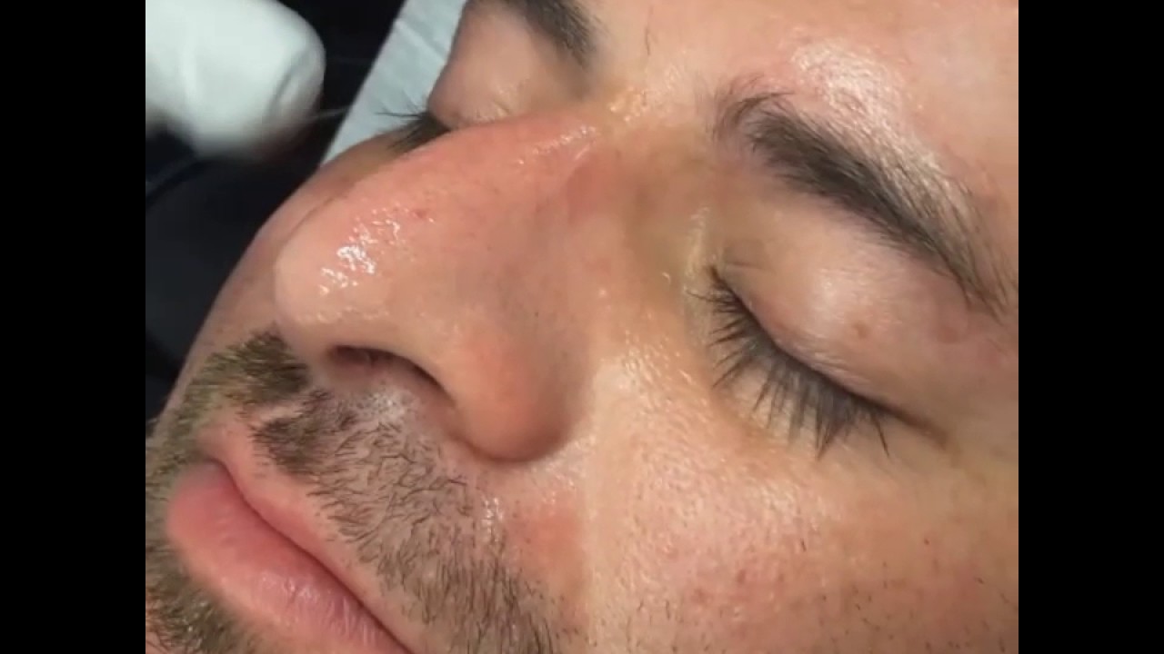 Microneedling for blackheads and enlarged pores on nose - Cozmetics Queen