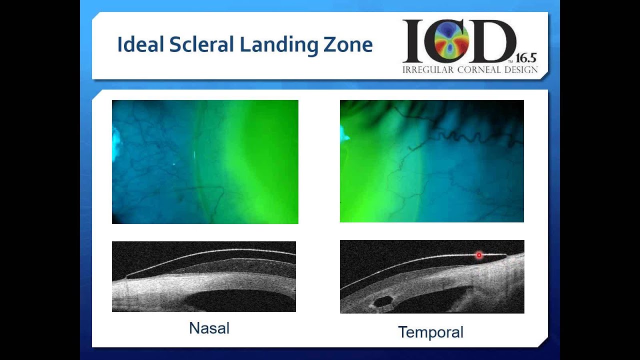Scleral Contact Lenses Video 5