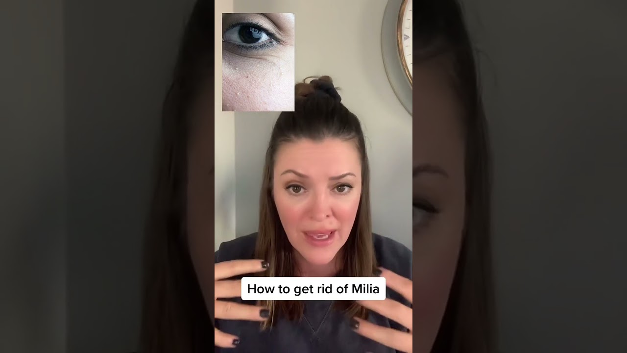 Say goodbye to milia with these effective tips #skin #skincare