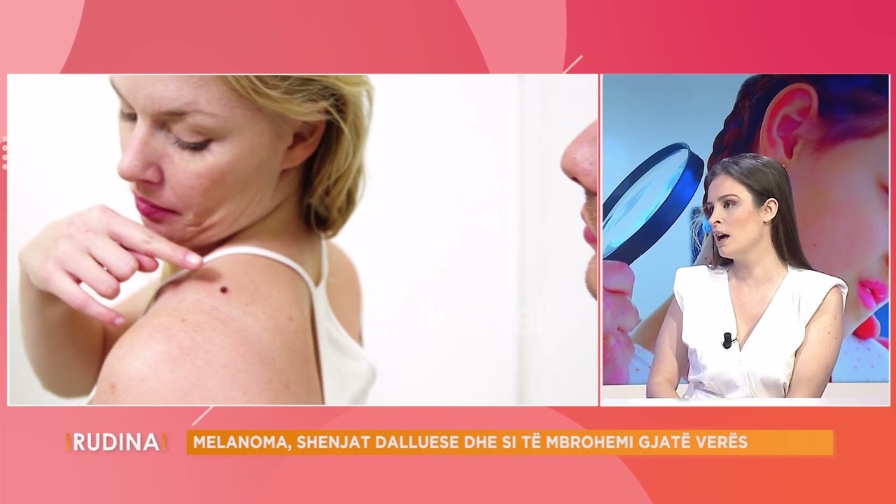 “Melanoma është agresive”, dermatologia:Arsyeja pse femrat kanë vdekshmëri më të ulët se meshkujt...