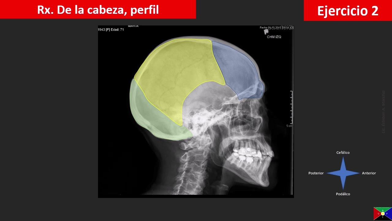 Huesos del cráneo en una radiografía de perfil