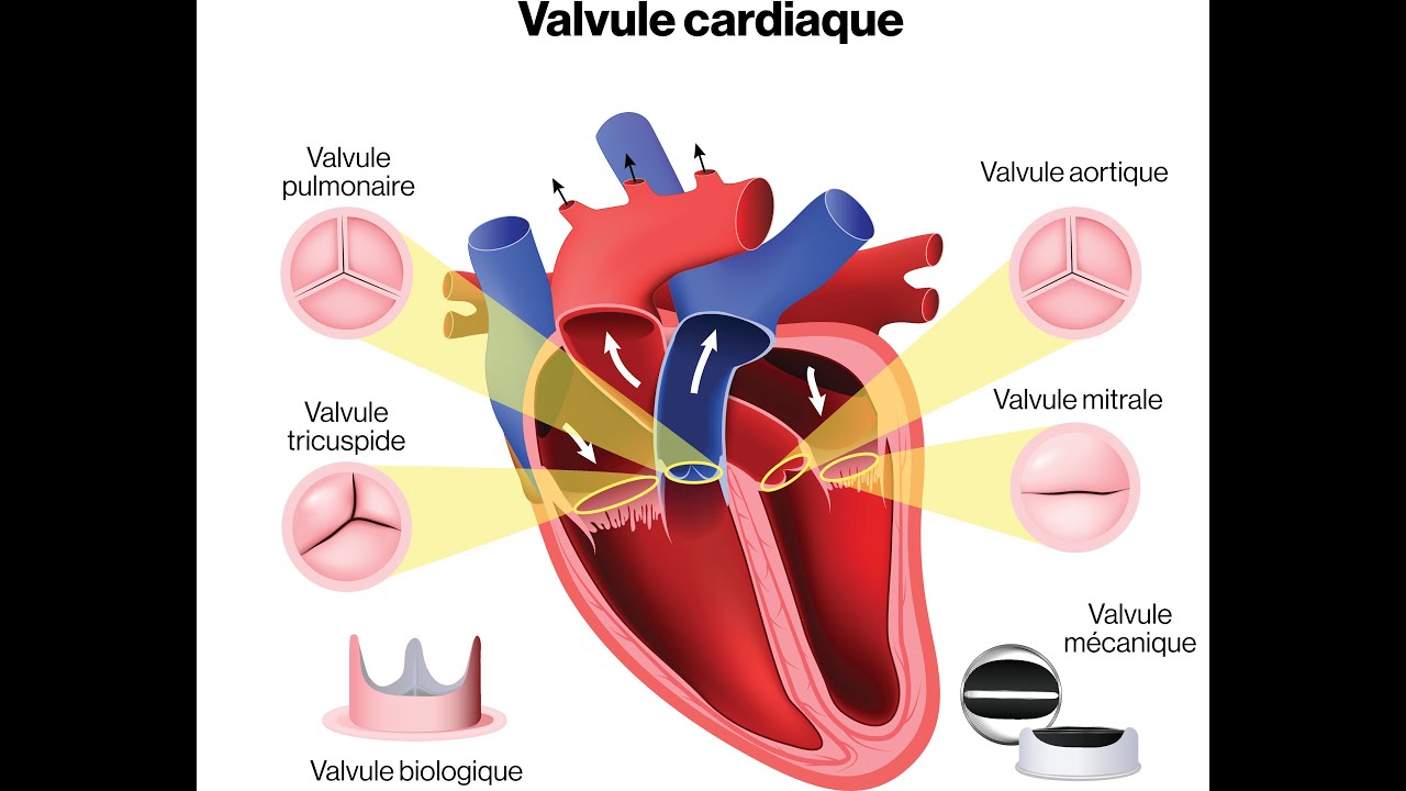 Chirurgie cardiaque | Les prothèse valvulaires cardiaques