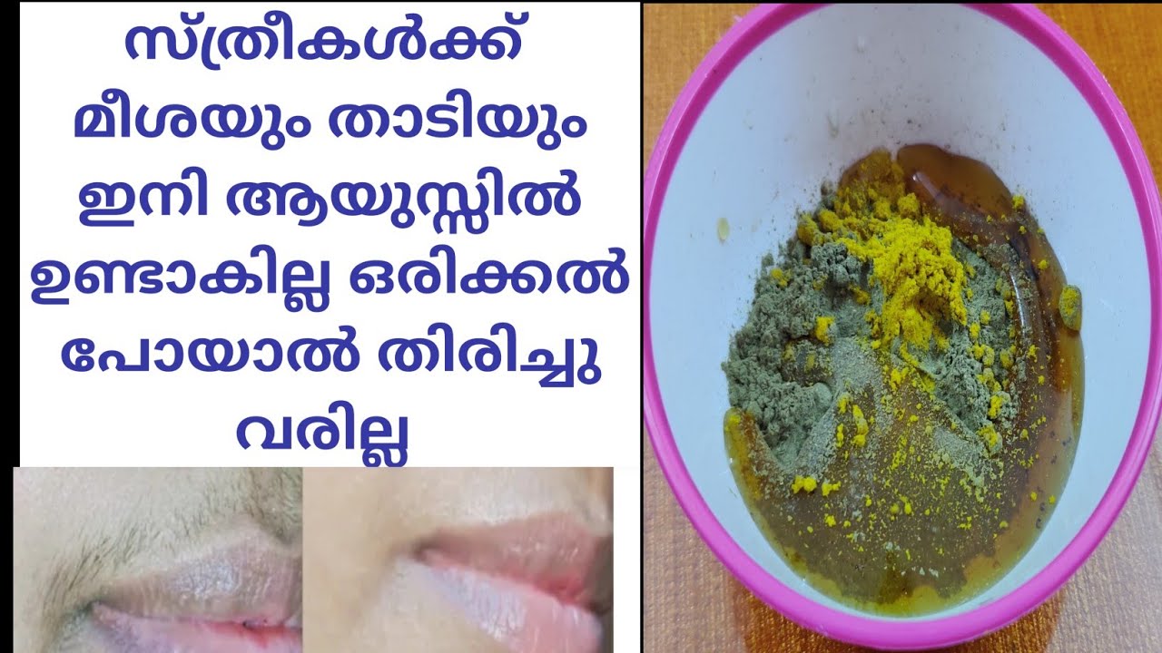 സ്ത്രീകൾക്ക് മീശയും താടിയും കളയാൻ ഇതിലും നല്ല വഴിയില്ല വീണ്ടും വളരില്ല /Face Skin Hair Removal Day 9