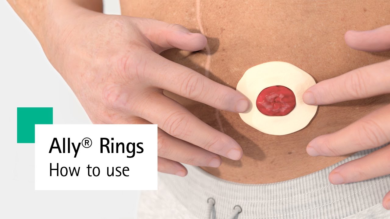 Ally® Rings – Ostomy Ring How to Use