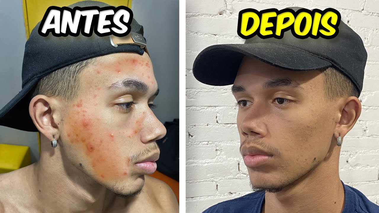 COMO ACABAR COM AS ESPINHAS DO ROSTO