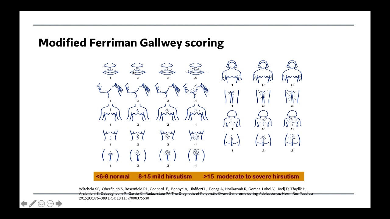 PCOS updated lecture