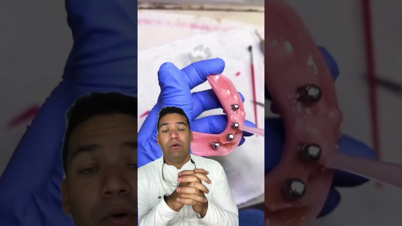 Pr&oacute;tese protocolo provis&oacute;ria (ppp) #odontologia #dentes #dental #estetica #dentist #teeth