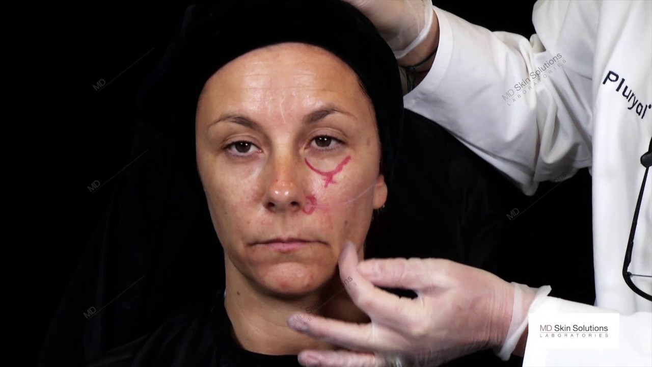 Mid-+ Lower third of the face with PLURYAL dermal fillers,  Dr Sabine ZENKER (Dermatology, Germany)