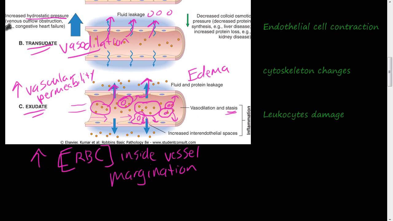 #19 - Acute Inflammation 1 of 3 - Vascular permeability, Vasodilation